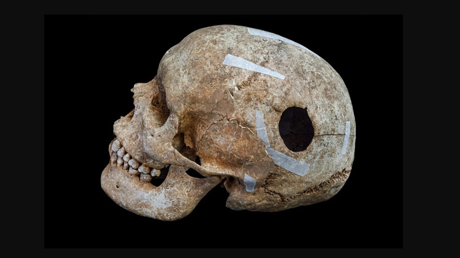 Eğitim kazısı sırasında bulunan, delik açılmış bir kafatası.