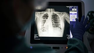 ARCHIVO - En esta foto de archivo del viernes 9 de julio de 2021, un sanitario revisa una radiografía en el Hospital del Mar de Barcelona, España.