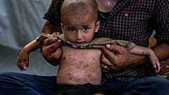 لطفل النازح محمد أبو عبيد، المصاب بمرض جلدي، يقف لالتقاط صورة بجانب والده في مخيم خيام مؤقت في دير البلح