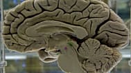 جزء من دماغ بشري محفوظ معروض في متحف التشريح العصبي بجامعة بوفالو في مدينة بوفالو بولاية نيويورك، يوم الثلاثاء 7 أكتوبر/تشرين الأول 2003