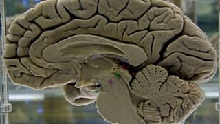 جزء من دماغ بشري محفوظ معروض في متحف التشريح العصبي بجامعة بوفالو في مدينة بوفالو بولاية نيويورك، يوم الثلاثاء 7 أكتوبر/تشرين الأول 2003