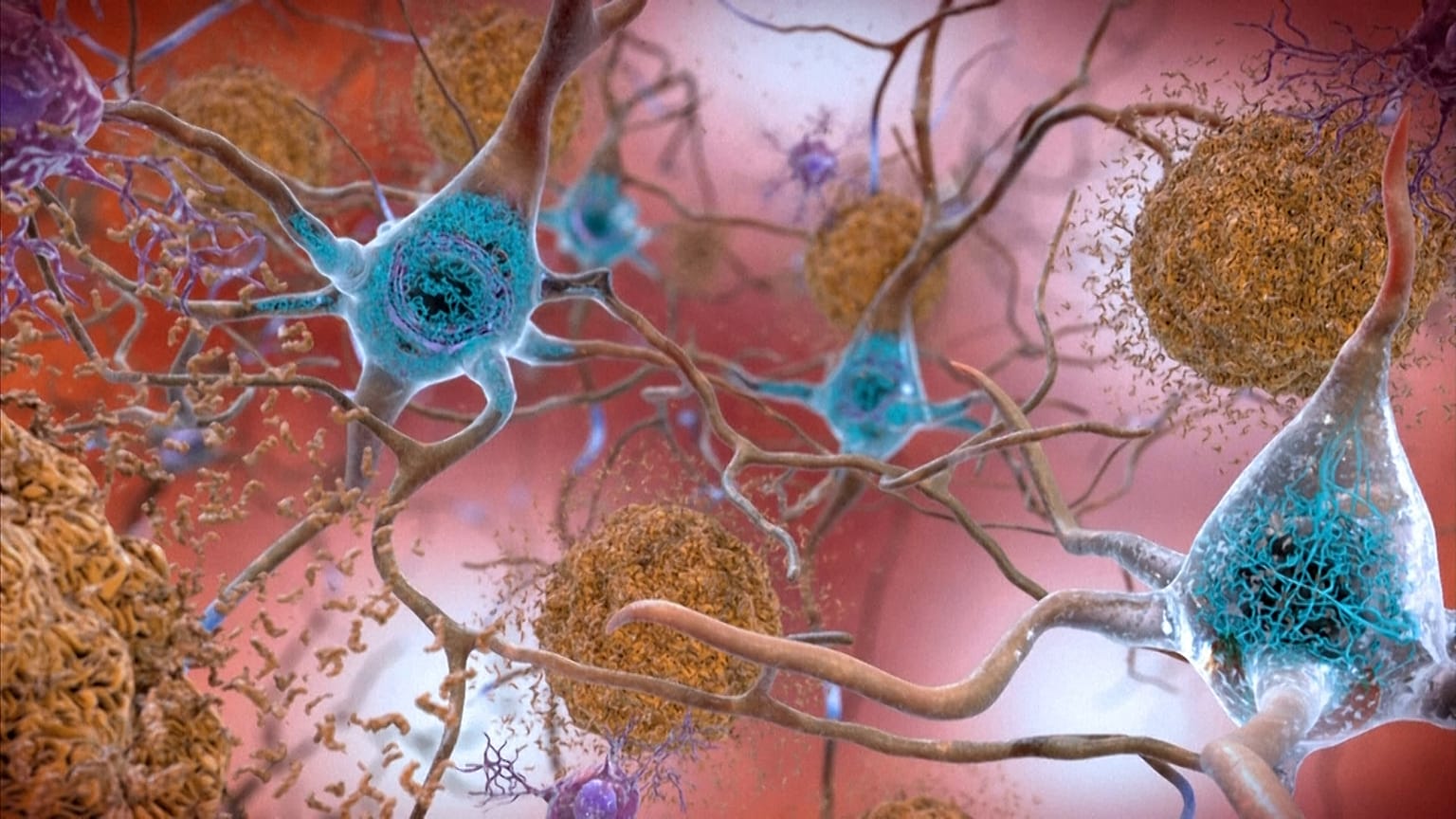 Illustration showing how tau and amyloid-β linked to dementia, form tangled sticky plaques in the brain