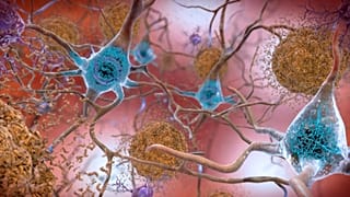 Illustration showing how tau and amyloid-β linked to dementia, form tangled sticky plaques in the brain