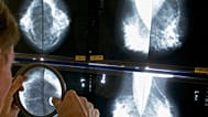 ARCHIVO - Un radiólogo utiliza una lupa para examinar mamografías en busca de cáncer de mama en Los Ángeles, el 6 de mayo de 2010. (Foto AP/Damian Dovarganes, Archivo)