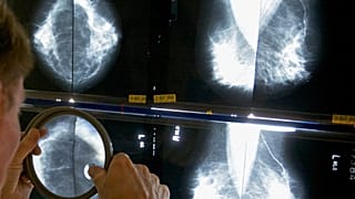 FILE - A radiologist uses a magnifying glass to examine mammograms for breast cancer in Los Angeles, on 6 May 2010. (AP Photo/Damian Dovarganes, File)