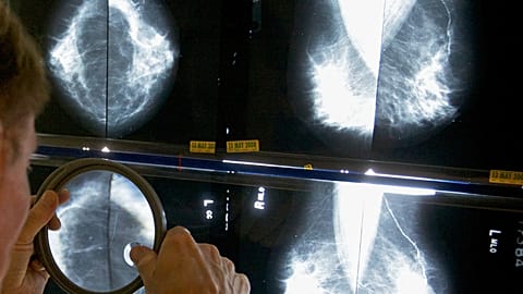 FILE - A radiologist uses a magnifying glass to examine mammograms for breast cancer in Los Angeles, on 6 May 2010. (AP Photo/Damian Dovarganes, File)