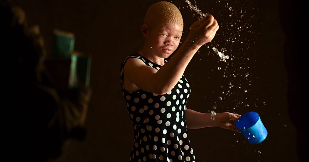 People with albinism get free cancer screening in Kenya