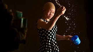 People with albinism get free cancer screening in Kenya