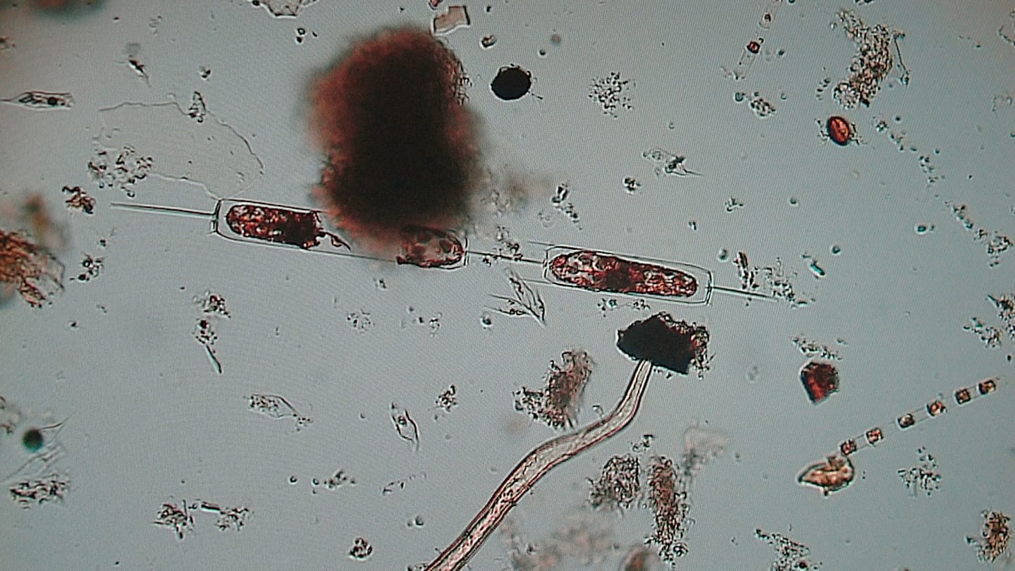 Recent 'flesh-eating bacteria' outbreaks worldwide