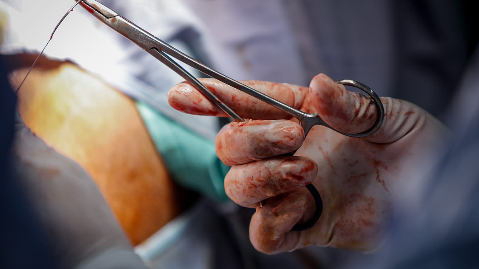 Médicos realizam uma cirurgia de reparação numa doente que tinha sido anteriormente submetida a mutilação genital feminina (MGF), na Somália, 8 de fevereiro de 2022 