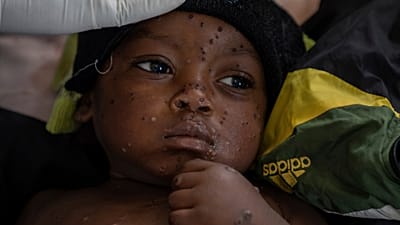 Guinée-Bissau : première épidémie de mpox, les enfants touchés principalement