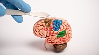 Traumatic brain injuries affect up to 69 million people annually. Such injuries can lead to post-traumatic epilepsy. 