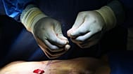 A plastic surgeon performs a belly bottom reconstruction plastic surgery after a tummy tuck in Beverly Hills, 5 February, 2026