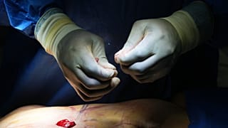 A plastic surgeon performs a belly bottom reconstruction plastic surgery after a tummy tuck in Beverly Hills, 5 February, 2026