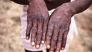 Kenya : les autorités alertent sur la propagation de la variole du singe