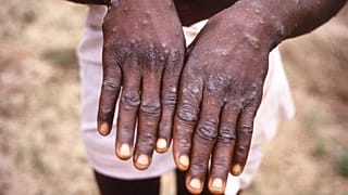Kenya : les autorités mettent en garde contre la propagation de la variole du singe