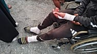 Imagen de las lesiones de un migrante herido. 