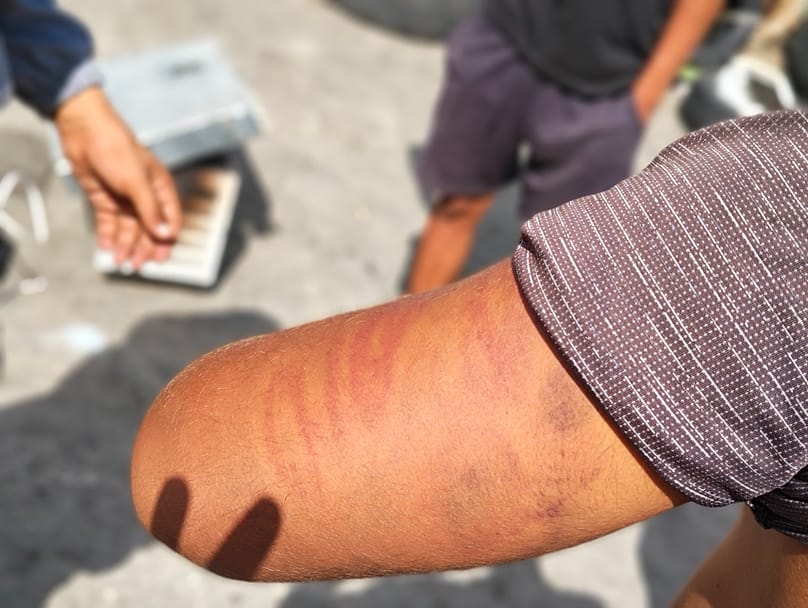 Un inmigrante con lesiones en el brazo.