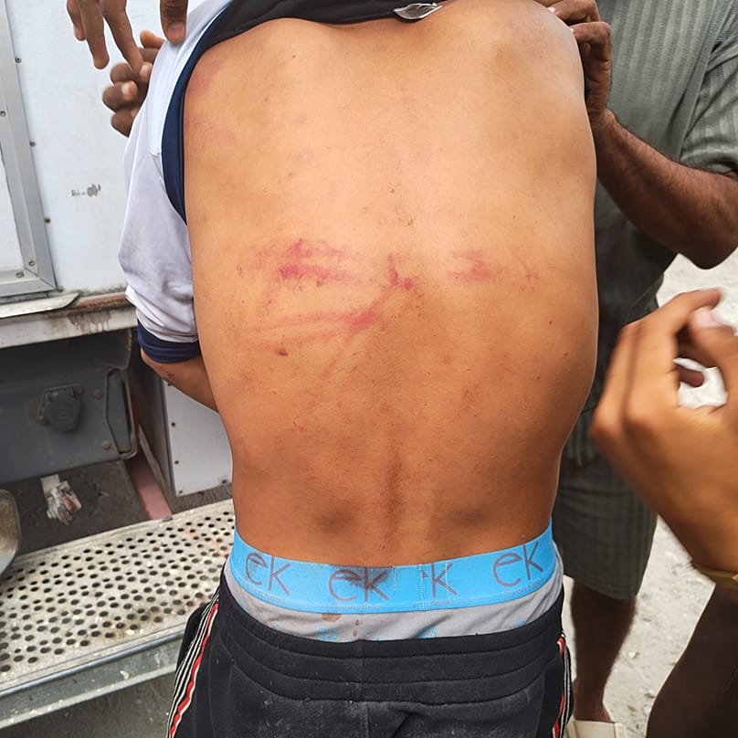 Un inmigrante con lesiones en la espalda.